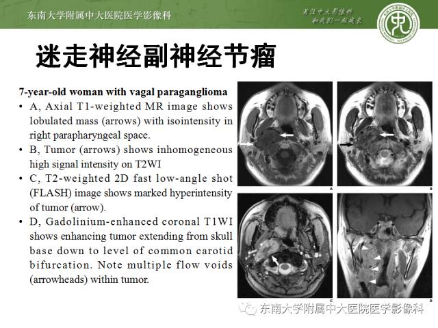 【病例】嗜铬细胞瘤2例CT影像表现