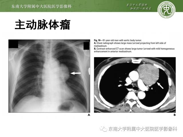 【病例】嗜铬细胞瘤2例CT影像表现