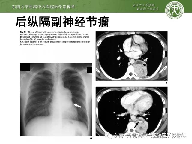 【病例】嗜铬细胞瘤2例CT影像表现