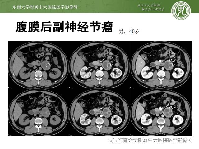 【病例】嗜铬细胞瘤2例CT影像表现