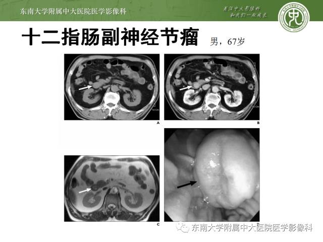 【病例】嗜铬细胞瘤2例CT影像表现