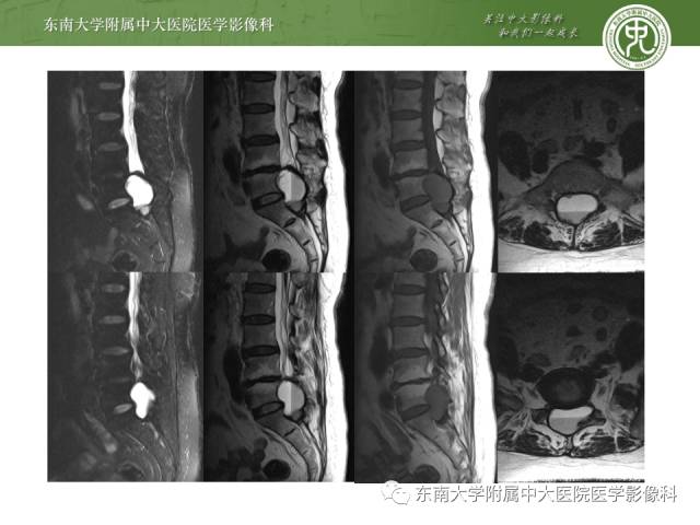 【病例】嗜铬细胞瘤2例CT影像表现