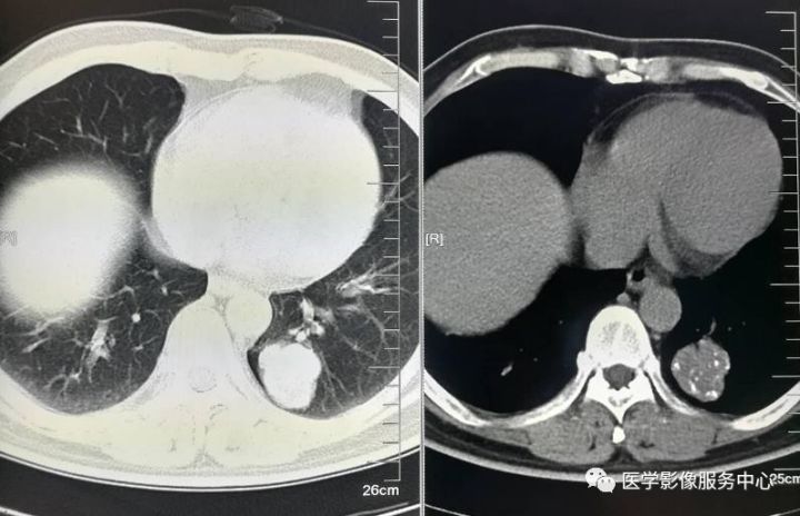 【病例】左肺下叶错构瘤1例CT 【病例】左肺下叶错构瘤1例CT