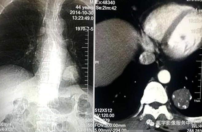 【病例】左肺下叶错构瘤1例CT 【病例】左肺下叶错构瘤1例CT
