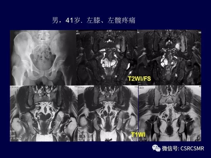 【PPT】骶骨病变的影像诊断与鉴别诊断