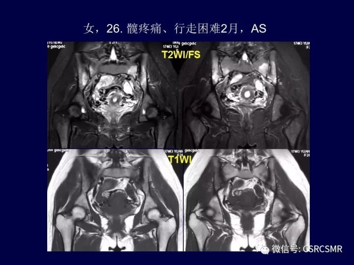【PPT】骶骨病变的影像诊断与鉴别诊断