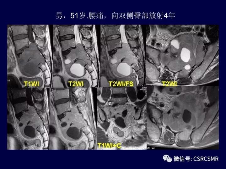 【PPT】骶骨病变的影像诊断与鉴别诊断