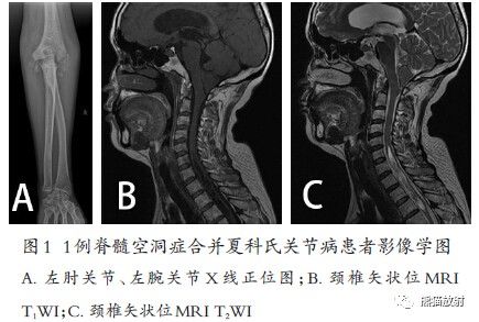 Charcot's关节(夏科氏关节)+影像表现 Charcot's关节(夏科氏关节)+影像表现