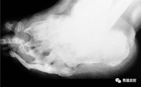 Charcot's关节(夏科氏关节)+影像表现 Charcot's关节(夏科氏关节)+影像表现