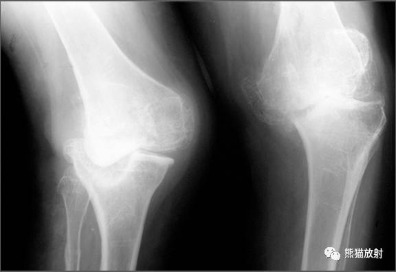 Charcot's关节(夏科氏关节)+影像表现 Charcot's关节(夏科氏关节)+影像表现