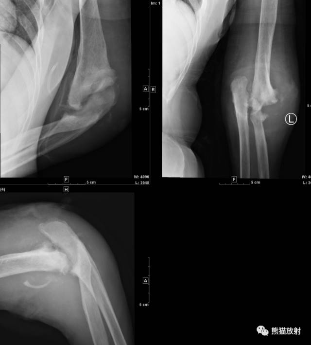 Charcot's关节（夏科氏关节）+影像表现