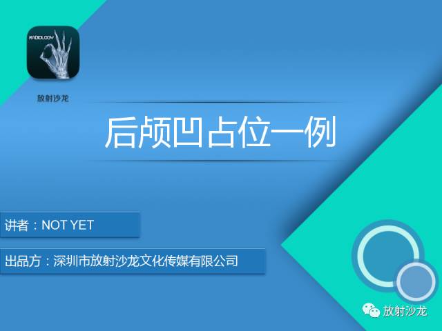 【病例】四脑室室管膜瘤1例MR