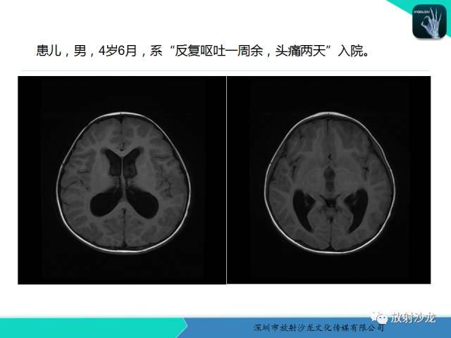 【病例】四脑室室管膜瘤1例MR