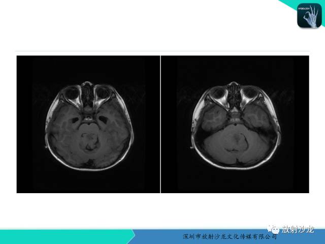 【病例】四脑室室管膜瘤1例MR