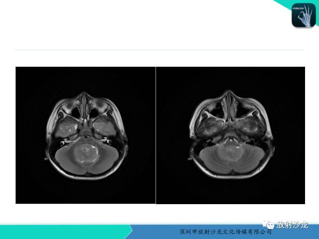 【病例】四脑室室管膜瘤1例MR