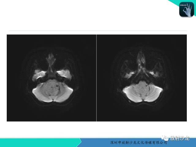 【病例】四脑室室管膜瘤1例MR