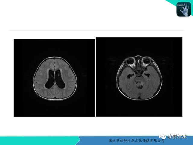 【病例】四脑室室管膜瘤1例MR