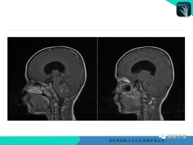 【病例】四脑室室管膜瘤1例MR