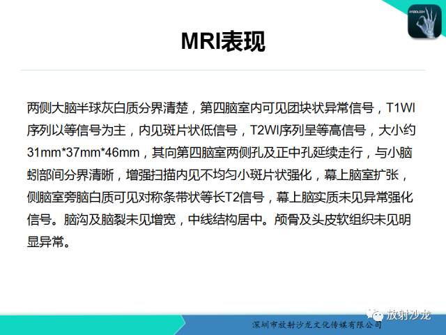 【病例】四脑室室管膜瘤1例MR