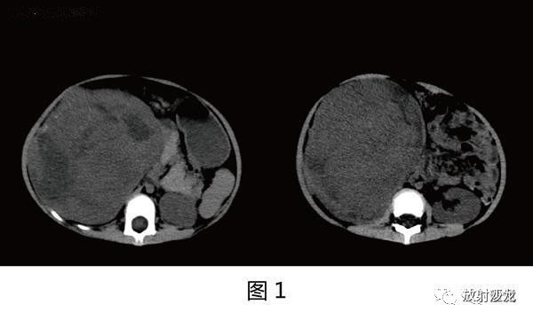 【病例】肾母细胞瘤1例CT