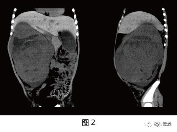 【病例】肾母细胞瘤1例CT