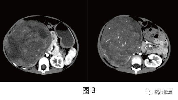 【病例】肾母细胞瘤1例CT