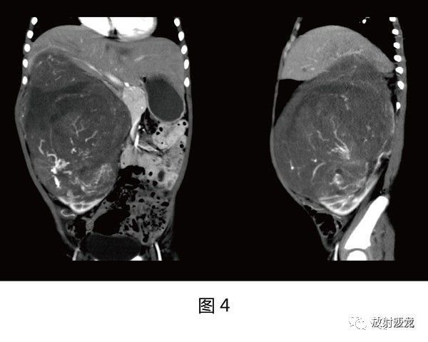 【病例】肾母细胞瘤1例CT
