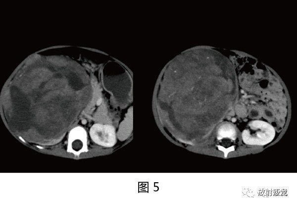 【病例】肾母细胞瘤1例CT