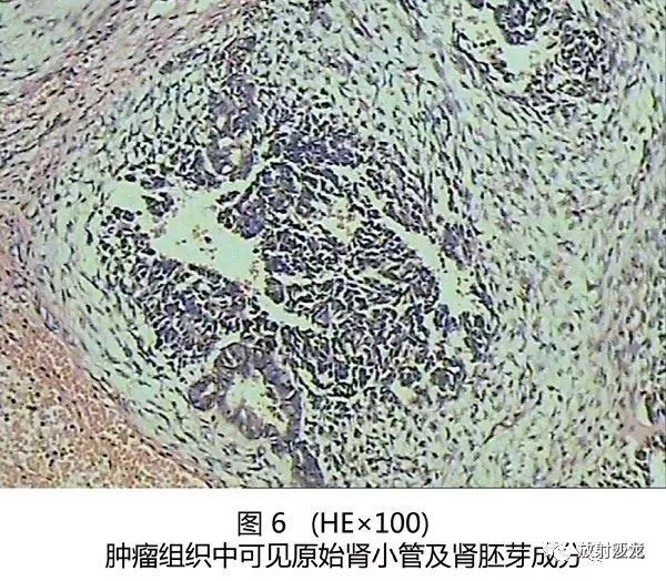 【病例】肾母细胞瘤1例CT