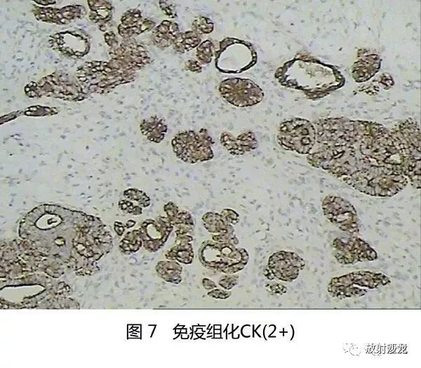 【病例】肾母细胞瘤1例CT
