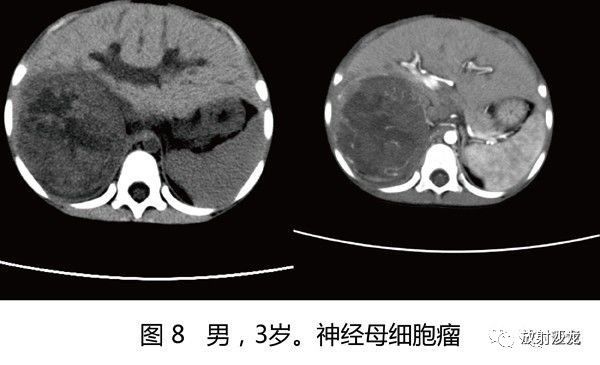【病例】肾母细胞瘤1例CT