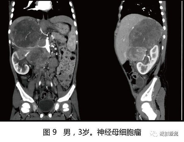 【病例】肾母细胞瘤1例CT
