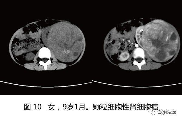 【病例】肾母细胞瘤1例CT
