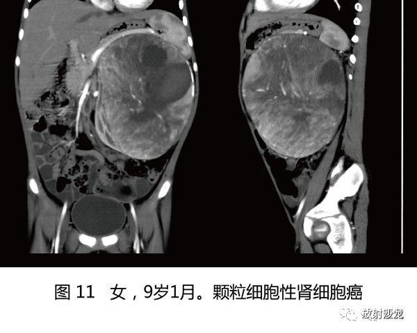 【病例】肾母细胞瘤1例CT