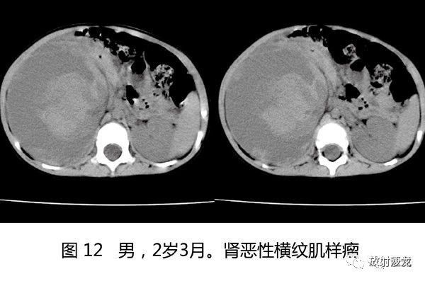 【病例】肾母细胞瘤1例CT