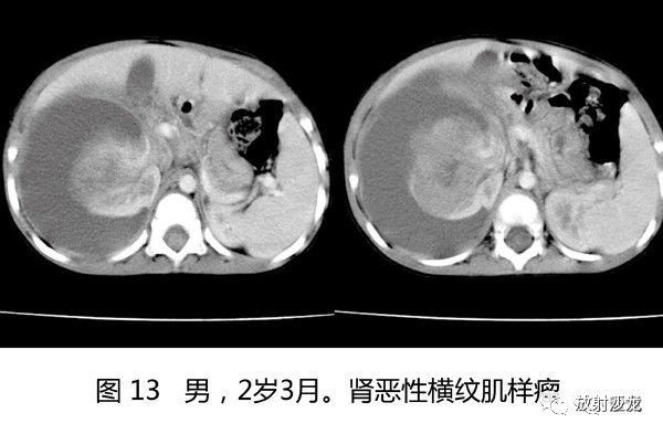 【病例】肾母细胞瘤1例CT