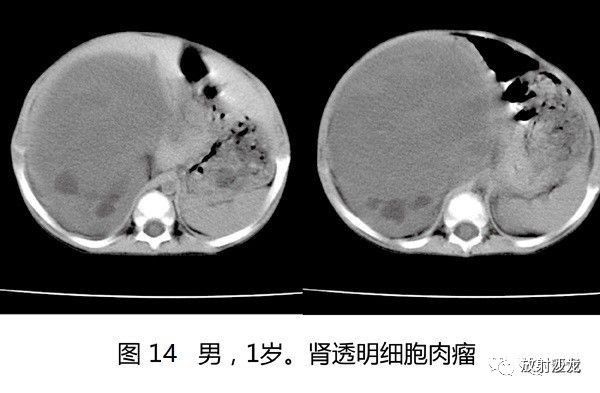 【病例】肾母细胞瘤1例CT