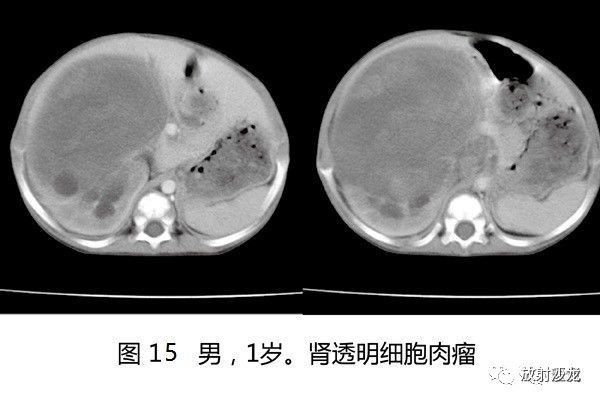 【病例】肾母细胞瘤1例CT