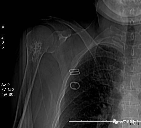 【病例】右侧肱骨软骨母细胞瘤1例X线CT