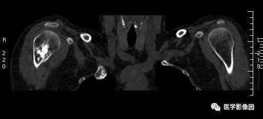 【病例】右侧肱骨软骨母细胞瘤1例X线CT