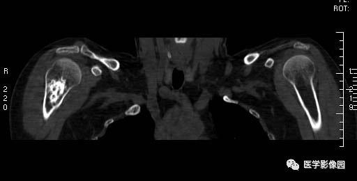 【病例】右侧肱骨软骨母细胞瘤1例X线CT