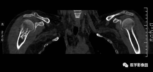 【病例】右侧肱骨软骨母细胞瘤1例X线CT