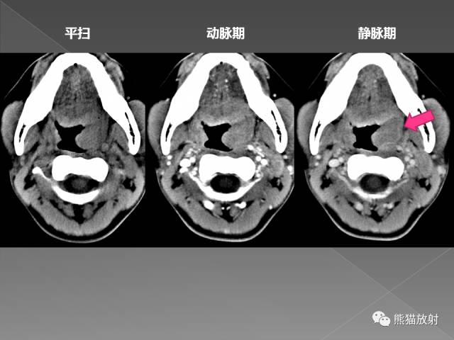 【PPT】扁桃体淋巴瘤——影像表现