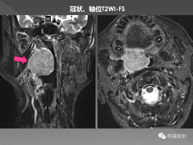 【PPT】扁桃体淋巴瘤——影像表现