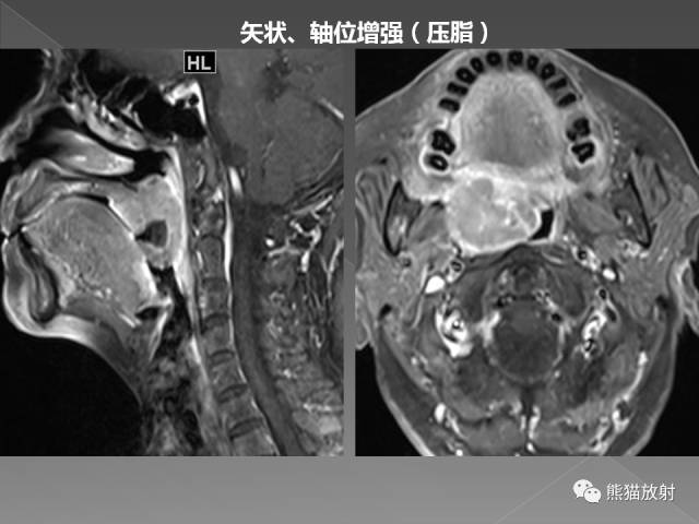 【PPT】扁桃体淋巴瘤——影像表现