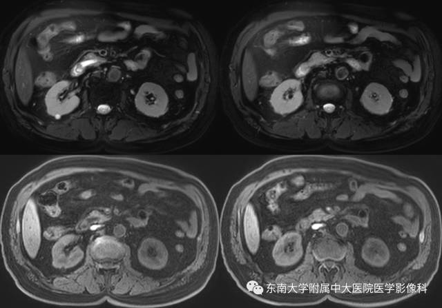 【病例】十二指肠乳头腺癌1例CT影像表现