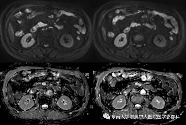 【病例】十二指肠乳头腺癌1例CT影像表现