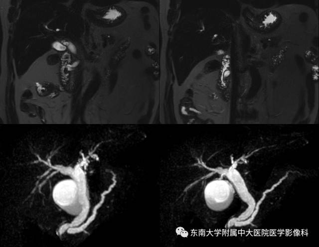 【病例】十二指肠乳头腺癌1例CT影像表现