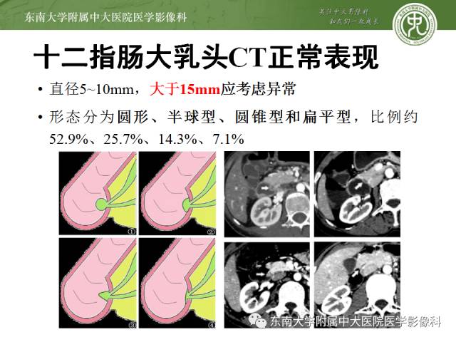 【病例】十二指肠乳头腺癌1例CT影像表现