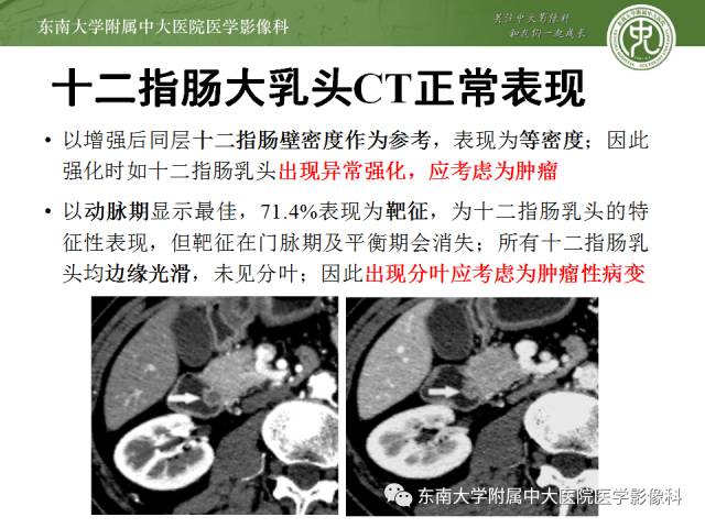 【病例】十二指肠乳头腺癌1例CT影像表现